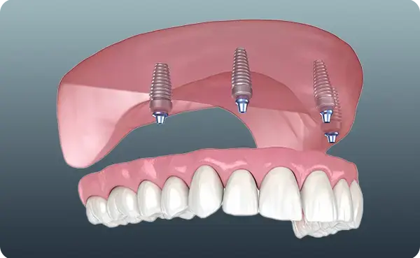 All-on-4 Implants