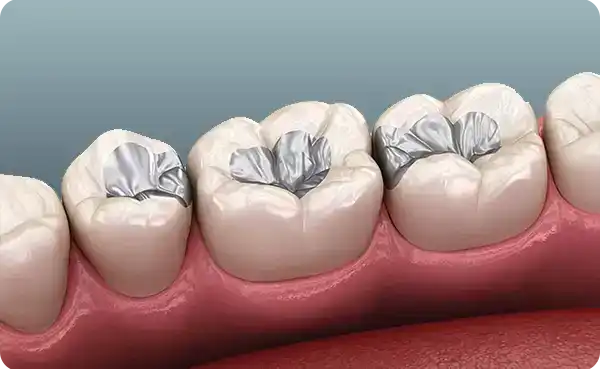 Tooth Fillings (Amalgam/Composite)