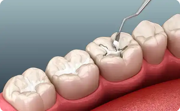Dental Sealants