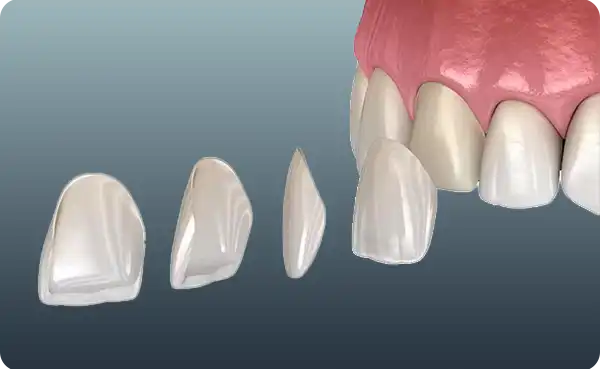 E-max Veneers
