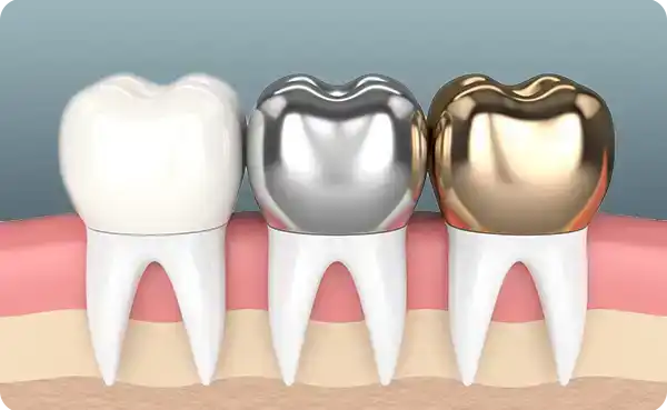 Metal Porcelain Crowns (PFM Crowns)