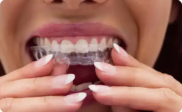 Bruxism Treatment (Night Guard)