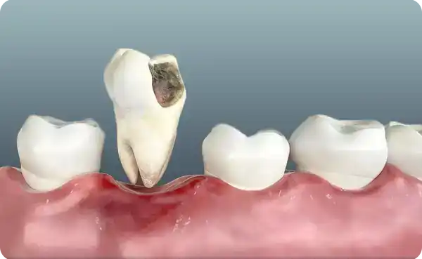 Root Canal Treatment