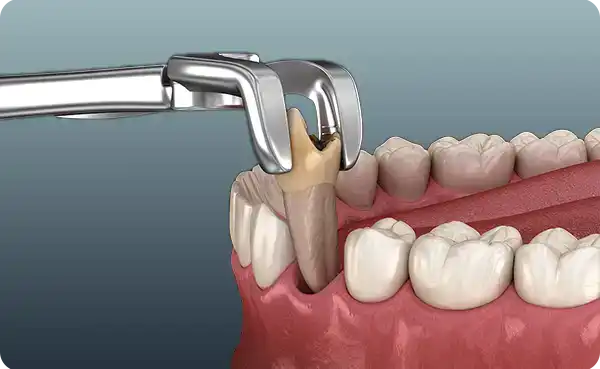 Tooth Extraction